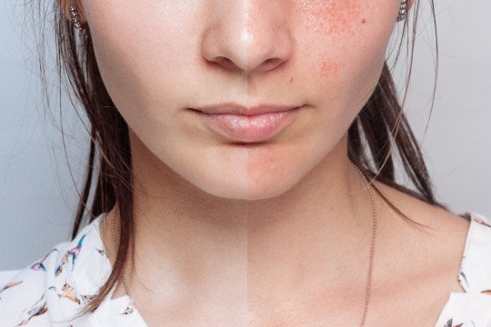 Haacht, Vlaams-Brabant, Artsen/specialisten plastische chirurgie, Artsen, Dermatoloog, Dermatoloog in de buurt, Juiste diagnose bij huidziekten, Aandoeningen aan de nagels, Anti rimpel bij dermatoloog