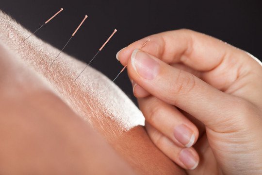 Acupuncturist, Chinese geneeskunde, Qi-gong, Burn-out, Hoofdpijnklachten, Rugklachten, Stress problemen, Gewichtproblemen, Geneesmiddelen, Slaapproblemen in Berchem, Antwerpen